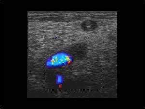 Thrombus filled lesser saphenous vein extending to the popliteal vein transverse | Lower ...