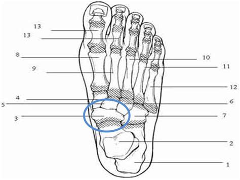 Kohler's Disease - Pain in the navicular (bone near ankle) - Greg ...