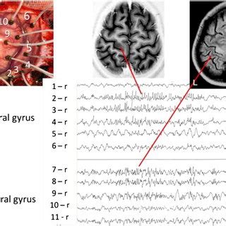 Intraoperative ECoG mapping the epileptogenic areas. | Download Scientific Diagram