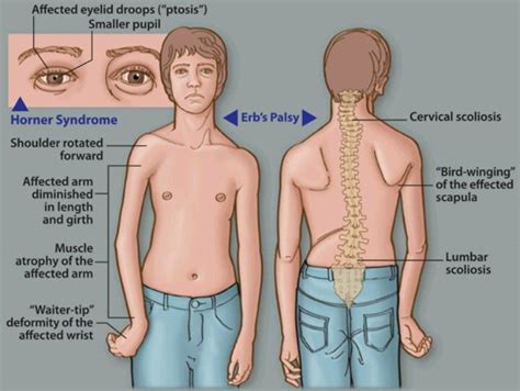 Erbs palsy | Plexus products, Pediatric physical therapy, Brachial