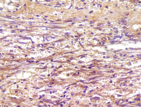 Hemangiosarcoma. Capillary type. Positive immunostaining against von ...