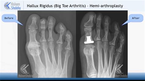 Big Toe Joint Replacement - Orthopaedic Foot & Ankle Surgeon ...