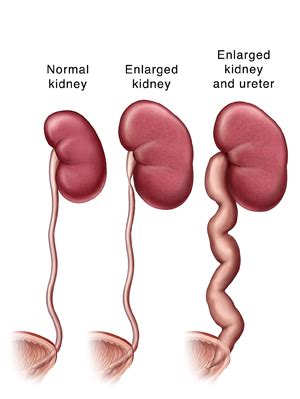 MNEMONICS: CAUSES OF ENLARGED KIDNEY