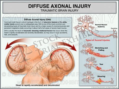 Brain Injury Diffuse Axonal Injury Trial Exhibit – Stock Trial Exhibits