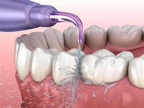 Waterpik vs. Flossing: Which is Best? - Lerner & Lemongello | Cosmetic and Restorative Dentistry