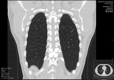 Evolución de la enfermedad pulmonar obstructiva crónica (EPOC)