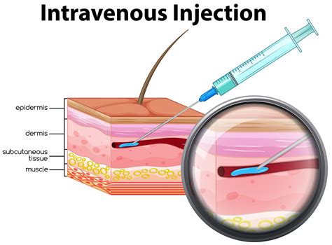 Intravenous injection on white background 433616 Vector Art at Vecteezy