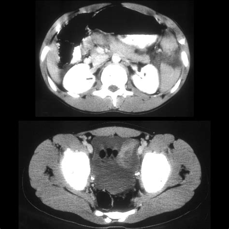 Teenager with abdominal pain after motor vehicle accident | Pediatric Radiology Case | Pediatric ...