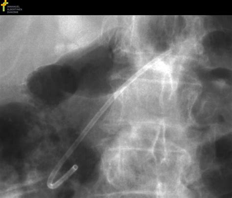 Dislocated pancreatic stent in small pelvis