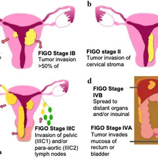 70-year-old woman with recurrent stage IVB uterine serous carcinoma ...