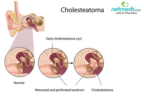 Cholesteatoma: Causes, Symptoms and Treatment