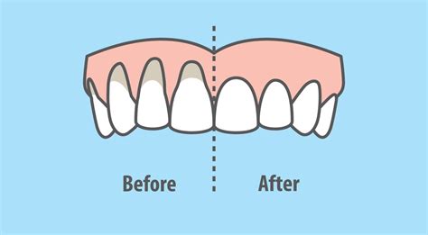 What Causes Gum Recession? - Spectrum Dental Group
