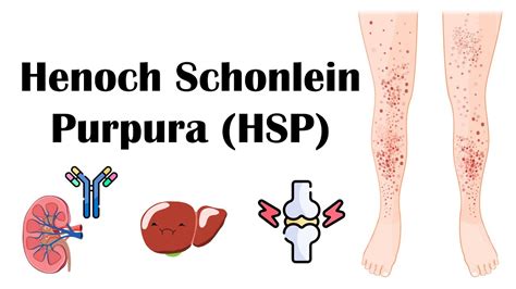 Henoch Schoenlein Purpura (HSP) - Causes, Pathophysiology, Diagnosis, And Treatment - YouTube