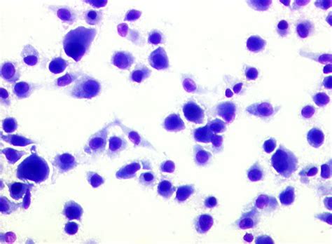 Pathology Outlines - Clear cell sarcoma