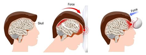 Head Injury & Audiology - ENT Blog