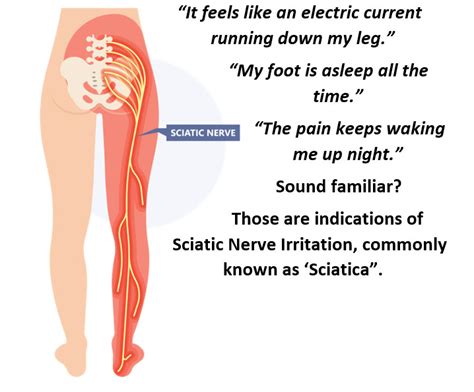 Sciatica, Radiating/Referred Pain, Neuropathy, Neuralgia • WellSpine KC