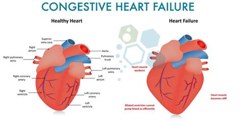 Congestive heart failure vs heart failure | doctorvisit