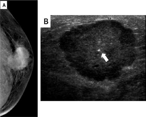 Invasive carcinoma in a 53-year-old man. A, Craniocaudal mammogram ...