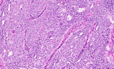 Pathology Outlines - Endometrioid carcinoma