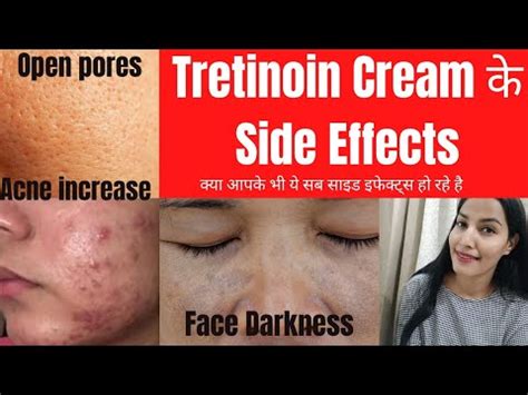 Tretinoin Or Retino-A के Side Effects||Acne का ज्यादा होना,Pores का ...