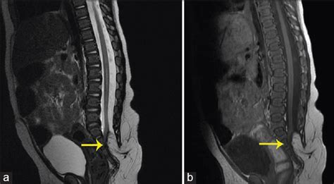 Intracranial subdural empyema after surgery for lumbar lipomyelomeningocele: A rare complication ...