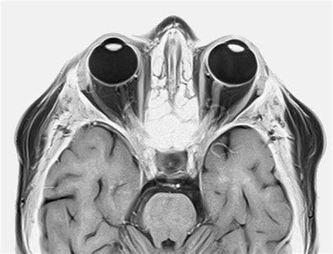 Optic Nerve Multiple Sclerosis Symptom Photograph by Zephyr/science ...