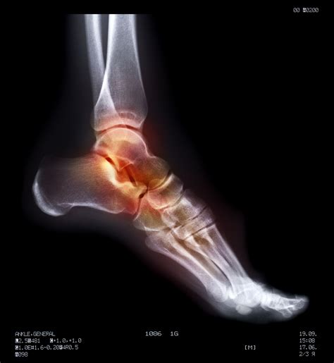 Common Foot Injuries Among Skaters