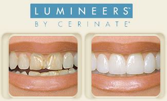 Lumineers Irving, TX | Veneers | Irving Family Dental