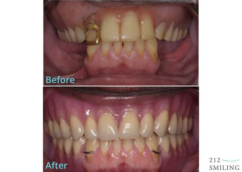 Dentures and Partial Dentures Male Before and After - 212 Smiling