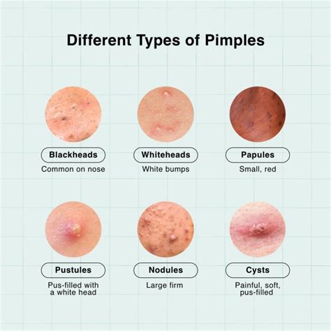 Why Am I Getting Pimples On My Chest Area at Kathleen Perry blog