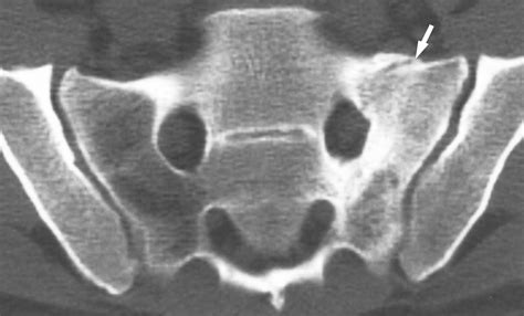 Fractured Sacrum - Fracture Treatment