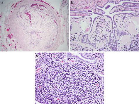 Laboratory Support for Diagnosis of Amyloidosis | Basicmedical Key