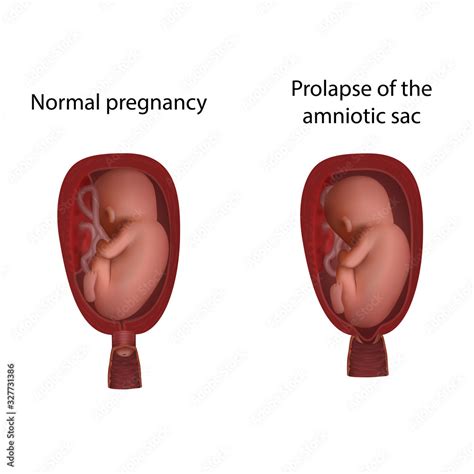 Normal and prolapse of the amniotic sac. Cervical weakness. Fetus in uterus, womb, placenta ...