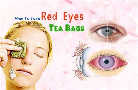 28 Tips How To Treat Red Eyes At Home Without Eye Drop