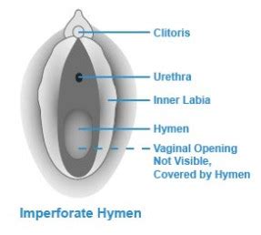 Hymen | Current Health Advice, Health Blog Articles and Tips