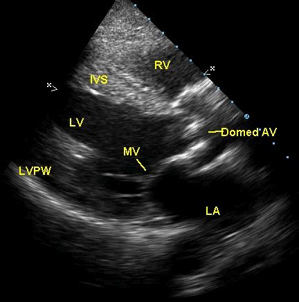 Echocardiographic profile in aortic stenosis – Echocardiogram video – All About Cardiovascular ...