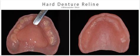 What is Denture Reline? - Shor Dental Blog Seattle