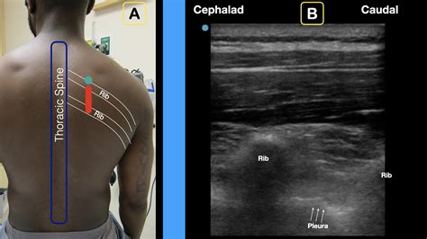 How to Perform an Erector Spinae Plane Block - ACEP Now