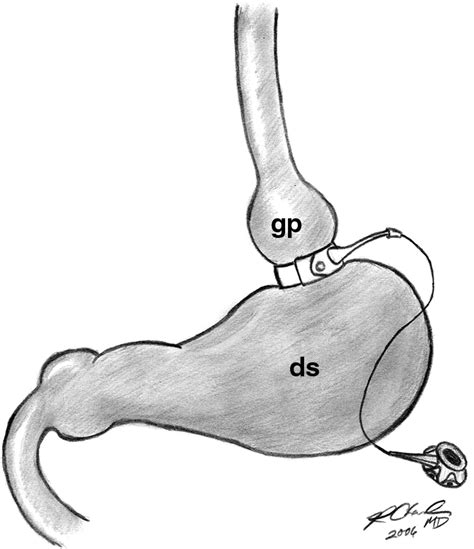 Vertical Banded Gastroplasty Complications