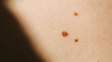 how does a cancerous mole look like | Symptoms and pictures