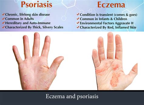 Whats The Difference Between Psoriasis And Eczema Eczema Association | My XXX Hot Girl