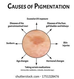 Pigmentation On Skin Causes Brown Spots Stock Vector (Royalty Free ...