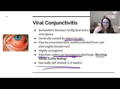 Adenoviral Conjunctivitis - Symptoms, Treatment In Children | Diseases 2024