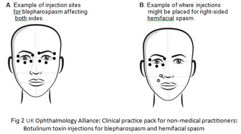 Blepharospasm Botox Before And After