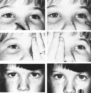 Afferent Pupillary Defect Marcus Gunn Pupil - Ocular Motor