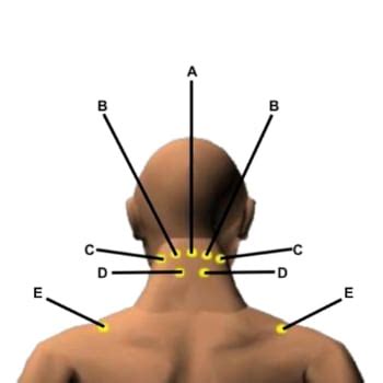 Massage Back Muscle Chart - Massage For Low Back Pain Erector Spinae : Extremities) clearly ...