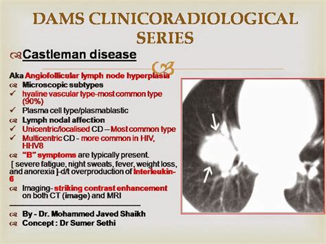 Castleman's Disease- Clinicoradiological Series - Sumer's Radiology Blog