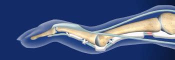 Swan Neck Deformity Surgery Dallas