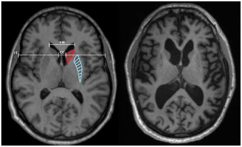 Huntington’s disease: Neuropsychiatric manifestations of Huntington’s ...