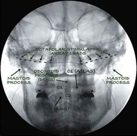 Occipital Nerve Stimulation | Anesthesia Key